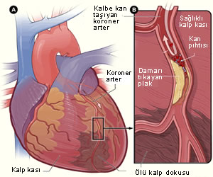 5717_kalp-krizi-ve-damar-tikanikligi