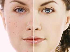 5782_acne-treatment-products