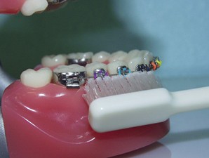 Diş Teli Temizliği Nasıl Yapılır?