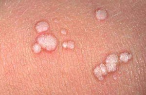 hpv_hastaligi