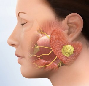 parotid-tumor
