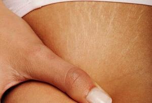 6050_three-natural-recipes-to-fade-off-stretch-marks