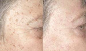6141_age-spots-4