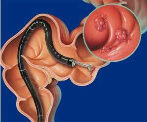 6195_endoscopy-colonoscopy