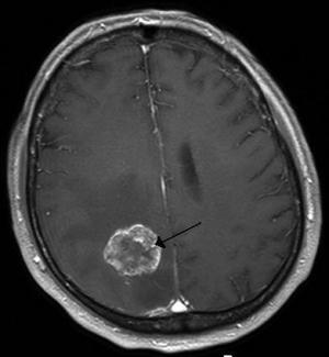 6280_hirnmetastase_mrt-t1_km
