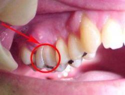 Çatlak Diş Sendromu Nedir, Teşhis ve Tedavisi Nasıldır?