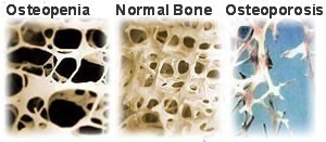7035_osteopenia