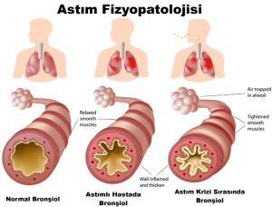 7338_anatomy-of-asthma2