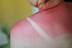 7415_sunburn