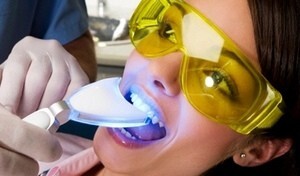 7744_advantages-of-laser-teeth-whitening