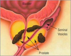 8081_prostate_cancer1