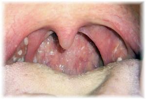 8369_angina_3