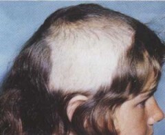 8393_trichotillomania-240x196