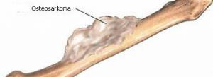 8398_bone-cancer-2zeokz1827s0of72qb9dkw