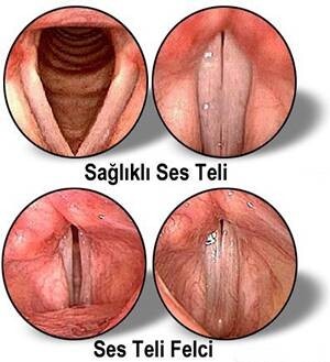 8470_ses_teli_1
