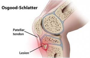 8550_osqood_schlatter