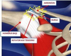 8578_impingement_sendrom