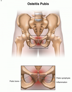 8578_ostoitis_pubis