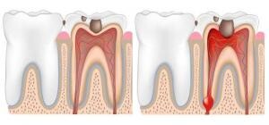8863_home-remedy-tooth-ache