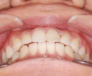 Diş Çürükleri Önceden Önlenebilir Mi?