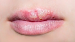 Uçuk Virüsü (Herpes Simplex Virüsü) Nasıl Bulaşır?