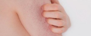 Keratosis Pilaris Tavuk Cildi Nedir? Başlıca Belirtileri Nelerdir?
