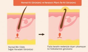 Keratosis Pilaris Tavuk Cildi Nedir? Başlıca Belirtileri Nelerdir?