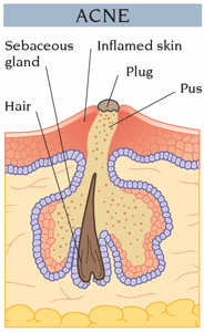 Akne Vulgaris Nedir? Nedenleri Ve Yapılması Gerekenler