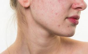 Akne Vulgaris Nedir? Nedenleri Ve Yapılması Gerekenler