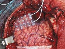 Epilepside Cerrahi Çözüm