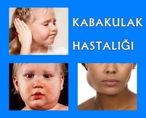 Kabakulak Hastalığı Belirtileri Ve Tedavisi