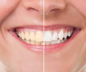 Diş Ağrılarının En Önemli 5 Nedeni