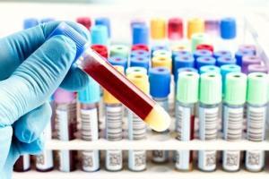 Sekiz Kanser Türü İçin Geliştirilen "CancerSEEK" Test Paneli Nasıl Çalışıyor?