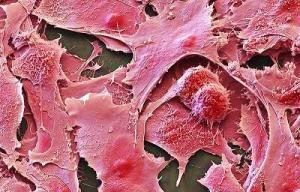 Sekiz Kanser Türü İçin Geliştirilen "CancerSEEK" Test Paneli Nasıl Çalışıyor?