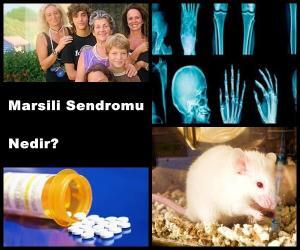 Marsili Sendromu Nedir?