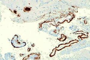 Alzheimer Başlamadan Önlenebilir mi?