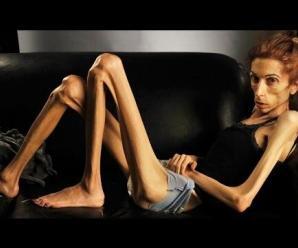 Anoreksi, Anoreksiya Nervoza ve Bulimia Nedir?