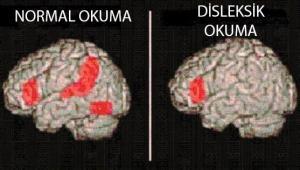 Disleksili Çocukların Okuma Becerileri Oyunlarla Artıyor mu?