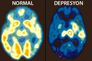 Depresyon Dilinin Özellikleri Nelerdir?