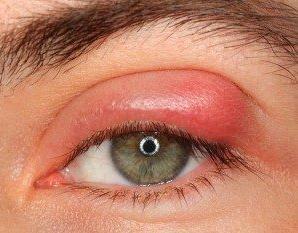 Göz Kapağı Hastalıkları Türleri ve Kapak Tümörleri