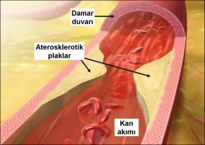 Damar Sertliği (Ateroskleroz) Nedir, Belirtileri ve Tedavisi Nasıldır ?