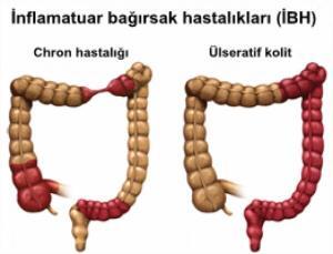 Crohn Hastalığı (İltihabi Bağırsak Hastalığı-İBH)