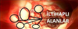 Crohn Hastalığı (İltihabi Bağırsak Hastalığı-İBH)