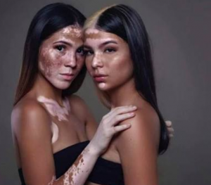 Vitiligo Hastalığının Tanısı ve Belirtileri
