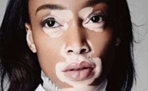 Vitiligo Hastalığının Tanısı ve Belirtileri
