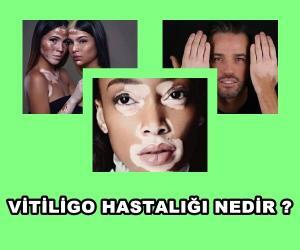 Vitiligo Hastalığının Tanısı ve Belirtileri