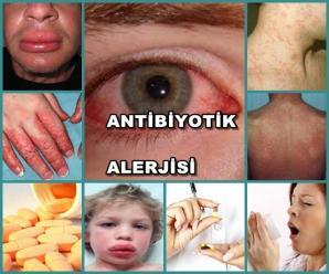 Antibiyotik Alerjisi Nedir? Belirtileri Nelerdir?