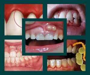 Diş Eti İltihabı (Gingivit) Nedir, Belirtileri ve Tedavisi Nasıldır ?