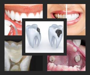 Diş Çürükleri Nedenleri ve Bitkisel Tedavi Yöntemleri