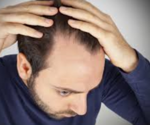 Erkeklerde Saç Dökülmeleri ve Çözümleri Nelerdir?